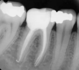 After root canal