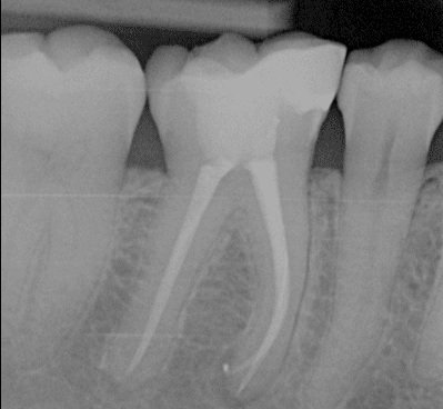 After root canal