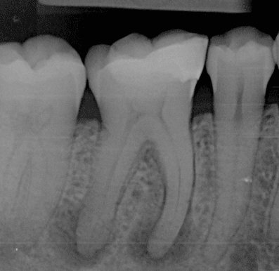 Before root canal