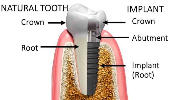 Dental implant procedure