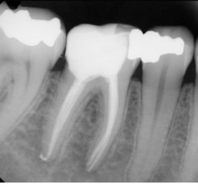 After root canal