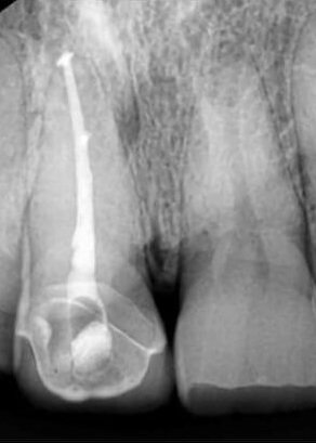 After root canal