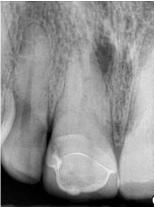 Before root canal